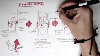 Bone Fracture  Types Fracture Repair and Osteomyelitis [upl. by Grissel]