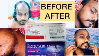 Minoxidil Beard Growth  दाढ़ी को जल्दी कैसे बढ़ाएं [upl. by Adhamh]