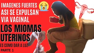 Miomas uterinos Còmo se expulsan vìa vaginal story time imàgenes fuertes [upl. by Ellwood]