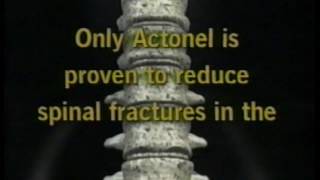 Actonel  Osteoporosis Medication Commercial  60 second Spot 2001 [upl. by Winfrid244]