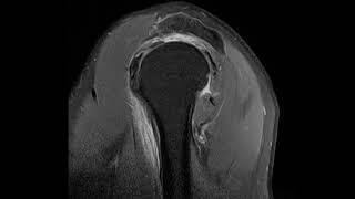 Massive rotator cuff tear [upl. by Nuaj]