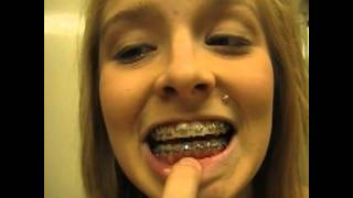 Braces Answering Your questions 4 Elastics [upl. by Marya]