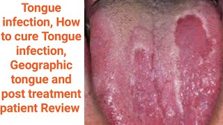 Geographic tongue Tongue infection Mouth inside infection benign migratory glossitis causes amp Tt [upl. by Fogel]