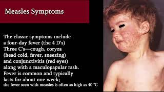 Measles  Symptoms Treatment and Complications Red rush [upl. by Reyem]