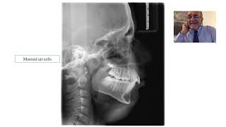 Landmarks on Lateral Cephalogram [upl. by Seve563]