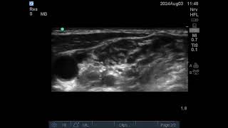 cricoid to scalene muscle scan for interscalene brachial block [upl. by Anastasio236]