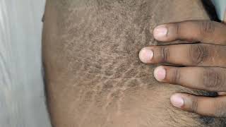 Acanthosis Nigricans [upl. by Enilraep]