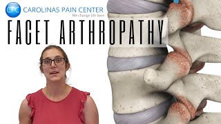 Natalie Explains Facet Arthropathy [upl. by Enelrahc]