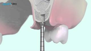 3DProtokoll Intralift mit TKWSpitzen [upl. by Ahtenek]