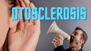 Otosclerosis  Otospongiosis  ENT Lecture [upl. by Dnomhcir]