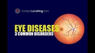 Eye Diseases  3 Common Eye Conditions [upl. by Siduhey]