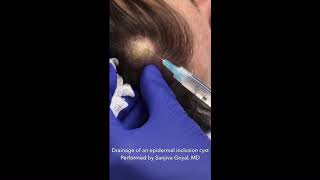 Drainage of an epidermal inclusion cyst on the scalp [upl. by Ahsoyek]