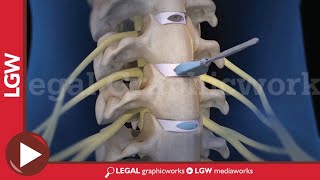 Cervical Discectomy amp Fusion Surgery 3D animation C3 C4 C5 C6 [upl. by Ainotal]