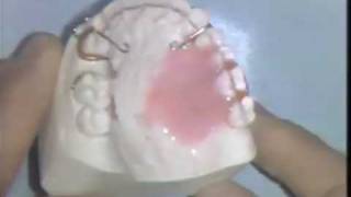 Orthodontic Acrylic Technique [upl. by Hashum166]