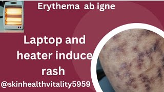 Erythema ab igneheater induced rashsignsymptoms and treatmenterythemaskinhealthvitality5959 [upl. by Hertzog822]