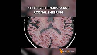 Colorized Brain Scans  Axonal Sheering [upl. by Nnaeoj245]