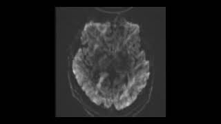 MRI BRAIN TBI Set 7 [upl. by Dalenna]