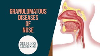 GRANULOMATOUS DISEASES OF NOSE part 3 mucormycosis wegeners granulomatosis in detail [upl. by Teraj]