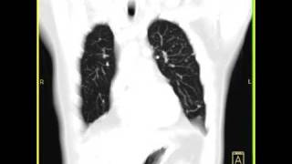 Lung Anatomy Sarcoidosis [upl. by Aikemal]