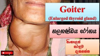 Goiter ගලගණ්ඩය රෝගය how it happens causes symptoms treatments how to prevent [upl. by Eisac]