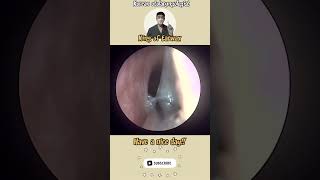 귀지형 콧물 부비동염 축농증 비염 코청소 이비인후과 rhinorrhea rhinitis sinusitis asmr [upl. by Theodosia]