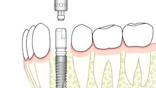 Ankylos™ – surgical and prosthetic procedure  Dentsply Sirona [upl. by Yul228]