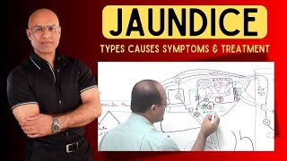 Jaundice  Types Causes Symptoms and Treatment [upl. by Braden]