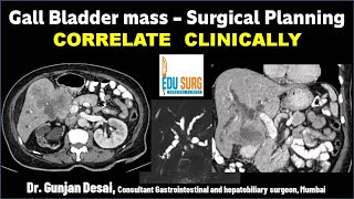 Gall Bladder cancer Surgical planning on CT scan Triphasic CT liver protocol  Correlate clinically [upl. by Glenna131]