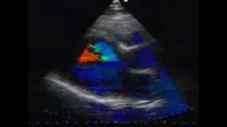 Hypertrophic cardiomyopathy echo case by dr Chatziathanasiou [upl. by Kcirttap]