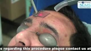 Acne Laser Therapy [upl. by Mikaela732]