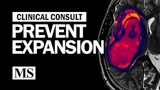 Clinical Consult Prevent Expansion [upl. by Eisse]