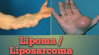 Lipoma  Liposarcoma Cancer Pathology Oncology Cancer [upl. by Buyers]