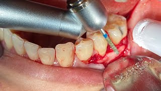 OSSEOUS SURGERY AT LOWER MOLAR [upl. by Airliah]