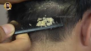 Removing Psoriasis From Scalp Dandruff Scratching 253 [upl. by Weingartner596]