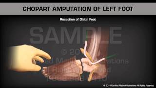 Chopart Amputation Left Foot [upl. by Ettenom]