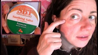 Skin Reaction Disaster How I Recovered My Rosacea Prone Face not sponsored  Rosy JulieBC [upl. by Ruford]