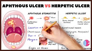 Herpetic ulcer vs Aphthous ulcer Aphthous stomatitis How to diagnose [upl. by Elorac]