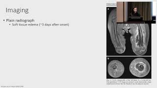 Osteomyelitis – An Antibiotic Update [upl. by Aicilif]