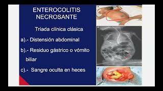 Enterocolitis necrotizante para el ENARM 2024 [upl. by Naz443]