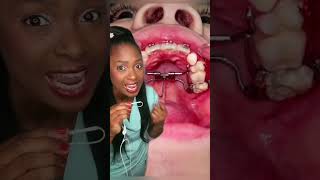 Activating a palate expander org vid orthotricks5313 expander braces [upl. by Matilde]