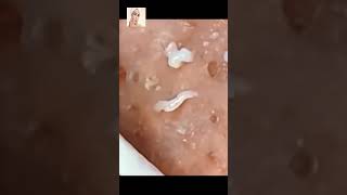 Blackheads Removal  Acne Treatment and Very Satisfying Satisfying Pimple pop blackheads [upl. by Nnayllek]