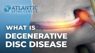 What Is Lumbar Degenerative Disc Disease  Intervertebral Disc Height Loss [upl. by Sarette775]