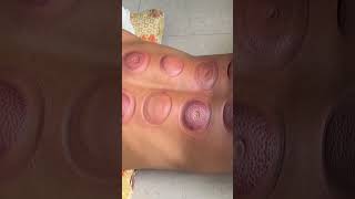 Cupping Therapy At Home 🏠  cupping therapy gym fitness [upl. by Onitnevuj]