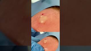 Forehead Cyst Squeezed  CONTOUR DERMATOLOGY shorts [upl. by Fletcher]