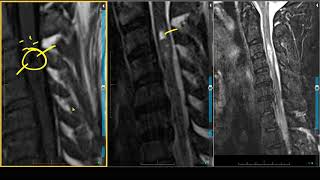 Hemangioblastoma on MRI [upl. by Afinom885]