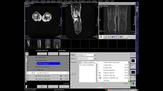 MR Venography  Lower Extremity MRI MRV MRA siemens technique [upl. by Lucila]