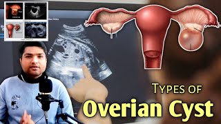 Types of Overian Cyst in Ultrasound by Dr Ali Waqar [upl. by Philip603]