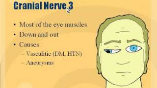 Neuro  Cranial Nerve 3 Palsy [upl. by Aisetra397]