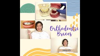 Things to know about orthodontic or dental braces [upl. by Aiciruam]