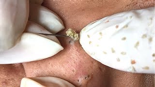 ACNE BLACKHEADS WHITEHEADS REMOVAL on face 38  How to get rid of pimple easy part [upl. by Suravat]